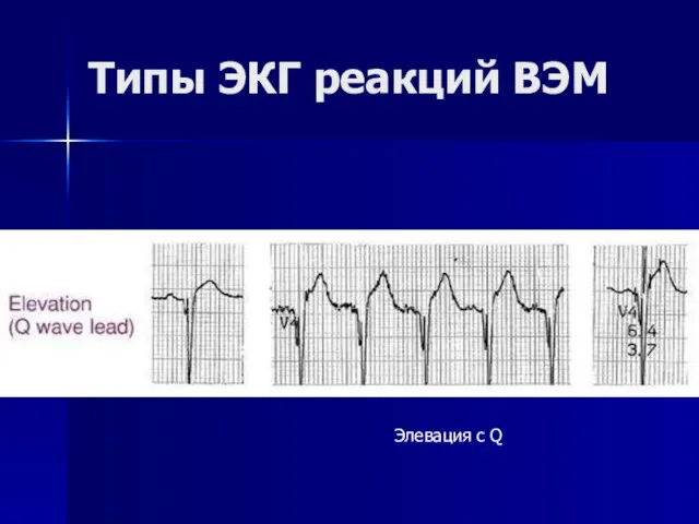 Типы ЭКГ реакций ВЭМ Элевация с Q