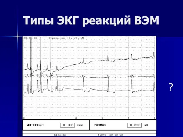 Типы ЭКГ реакций ВЭМ ?