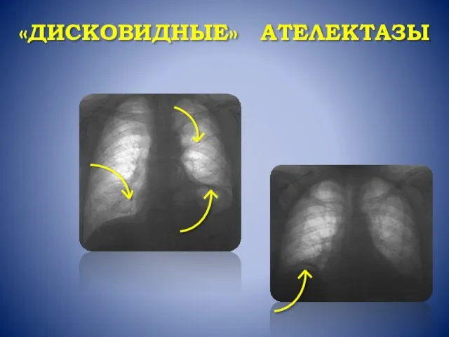 «ДИСКОВИДНЫЕ» АТЕЛЕКТАЗЫ