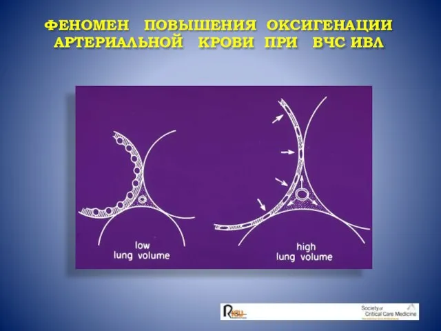 ФЕНОМЕН ПОВЫШЕНИЯ ОКСИГЕНАЦИИ АРТЕРИАЛЬНОЙ КРОВИ ПРИ ВЧС ИВЛ