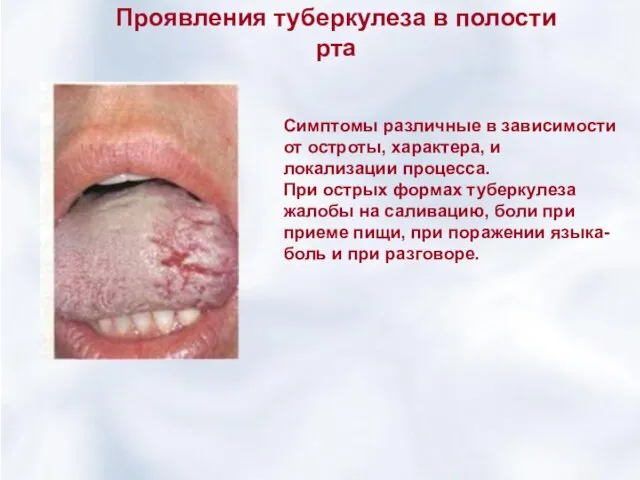 Проявления туберкулеза в полости рта Симптомы различные в зависимости от остроты, характера,
