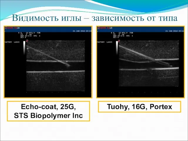 Видимость иглы – зависимость от типа Echo-coat, 25G, STS Biopolymer Inc Tuohy, 16G, Portex