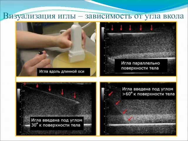 Визуализация иглы – зависимость от угла вкола