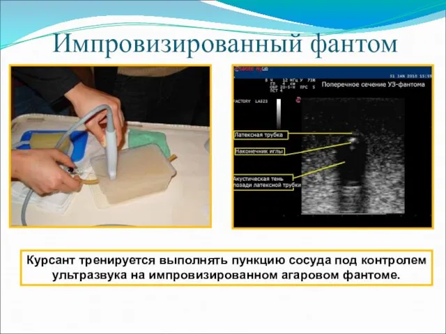 Импровизированный фантом Курсант тренируется выполнять пункцию сосуда под контролем ультразвука на импровизированном агаровом фантоме.