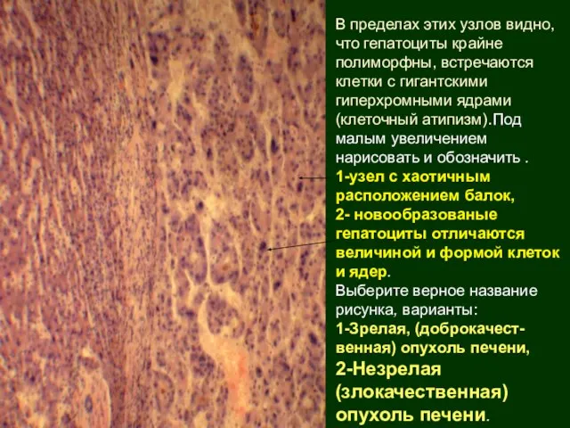 В пределах этих узлов видно, что гепатоциты крайне полиморфны, встречаются клетки с