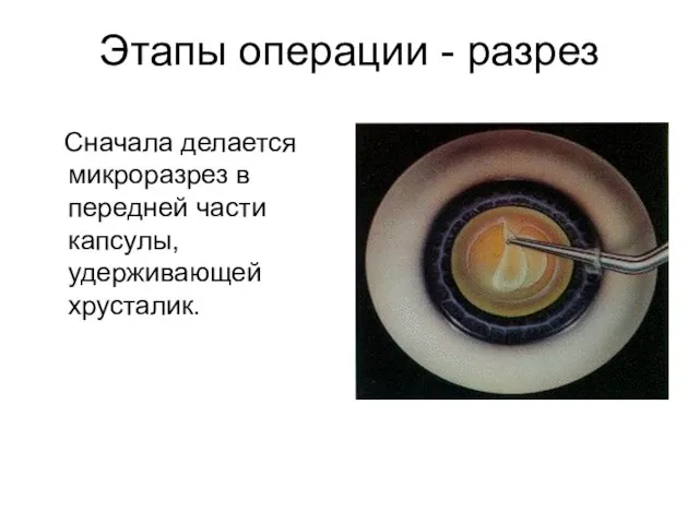 Этапы операции - разрез Сначала делается микроразрез в передней части капсулы, удерживающей хрусталик.