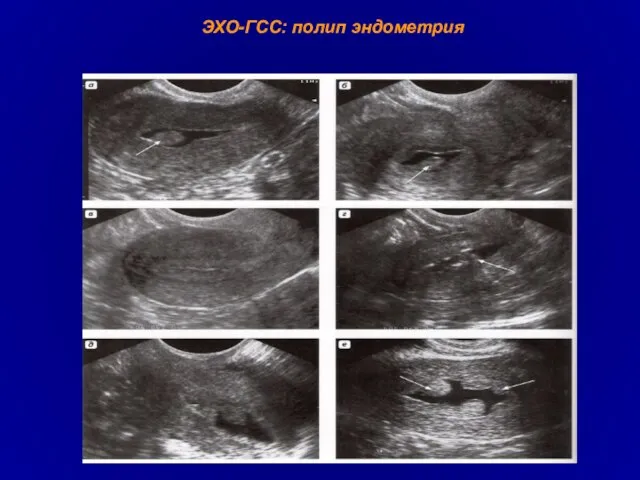 ЭХО-ГСС: полип эндометрия
