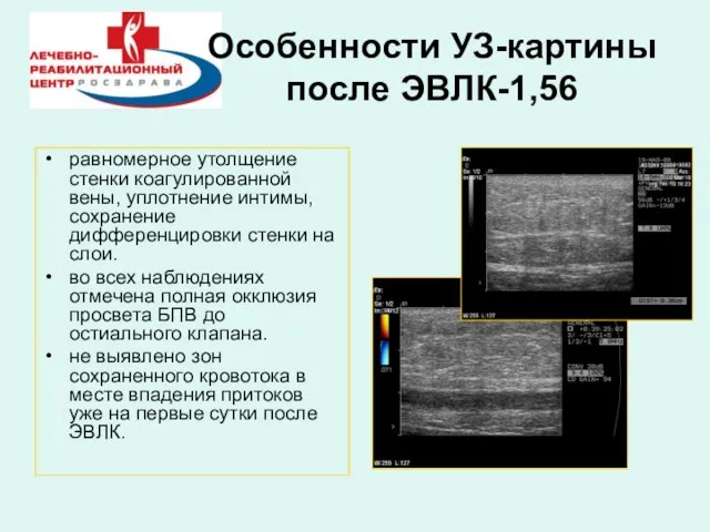 Особенности УЗ-картины после ЭВЛК-1,56 равномерное утолщение стенки коагулированной вены, уплотнение интимы, сохранение