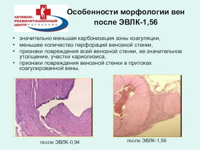 Особенности морфологии вен после ЭВЛК-1,56 значительно меньшая карбонизация зоны коагуляции, меньшее количество