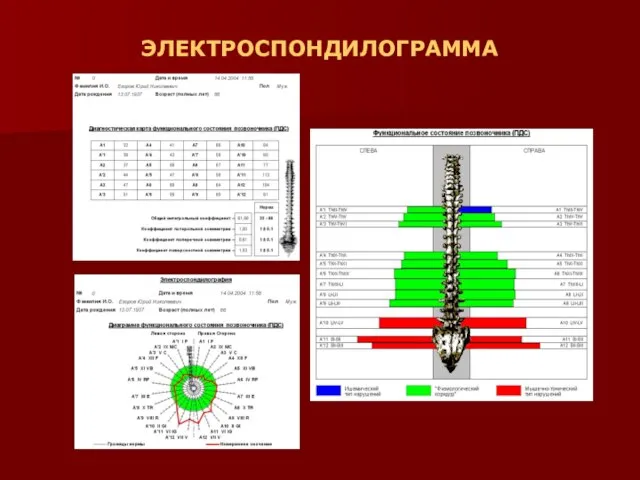 ЭЛЕКТРОСПОНДИЛОГРАММА