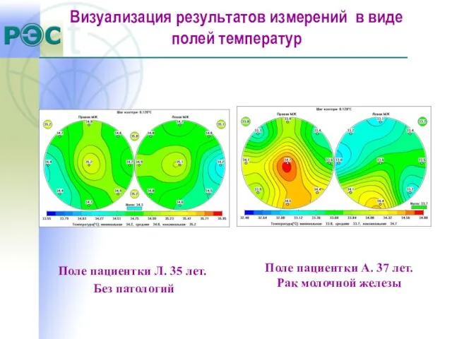 Визуализация результатов измерений в виде полей температур Поле пациентки А. 37 лет.