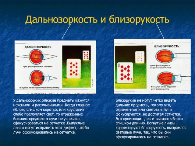 Дальнозоркость и близорукость У дальнозорких близкие предметы кажутся неясными и расплывчатыми .Когда