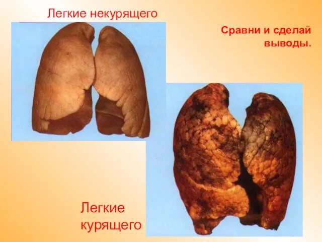 Сравни и сделай выводы. Легкие некурящего Легкие курящего