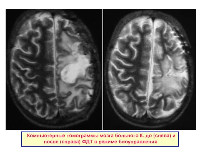 Компьютерные томограммы мозга больного К. до (слева) и после (справа) ФДТ в режиме биоуправления