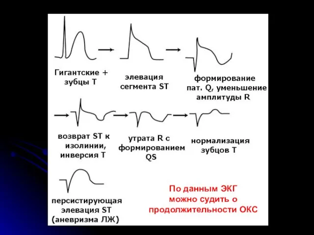 По данным ЭКГ можно судить о продолжительности ОКС