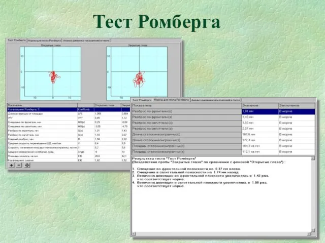 Тест Ромберга