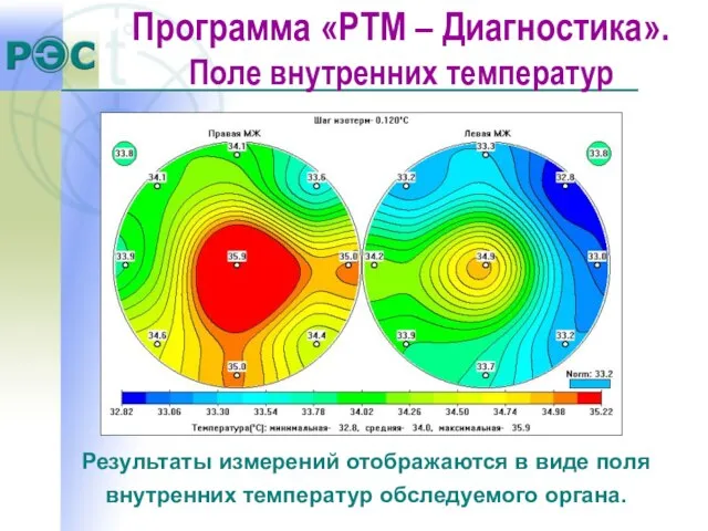 Результаты измерений отображаются в виде поля внутренних температур обследуемого органа. Программа «РТМ