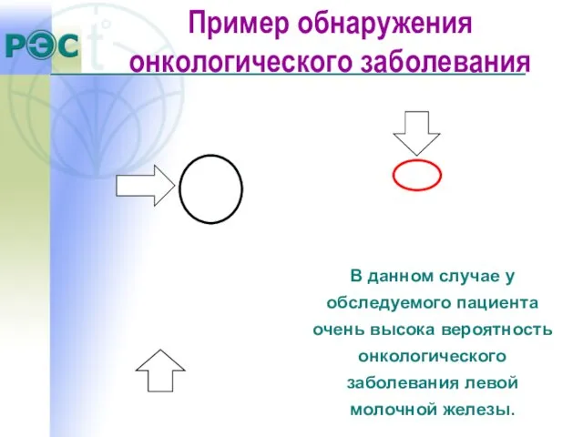 В данном случае у обследуемого пациента очень высока вероятность онкологического заболевания левой