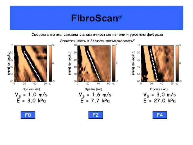 FibroScan® Скорость волны связана с эластичностью печени и уровнем фиброза Эластичность =