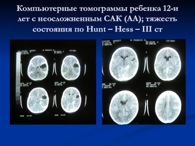 Компьютерные томограммы ребенка 12-и лет с неосложненным САК (АА); тяжесть состояния по