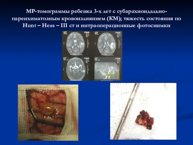 МР-томограммы ребенка 3-х лет с субарахноидально-паренхиматозным кровоизлиянием (КМ); тяжесть состояния по Hunt