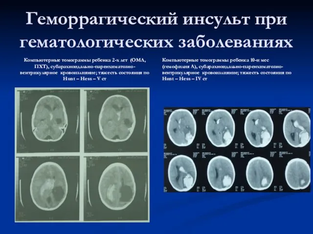 Геморрагический инсульт при гематологических заболеваниях Компьютерные томограммы ребенка 2-х лет (ОМЛ, ПХТ),