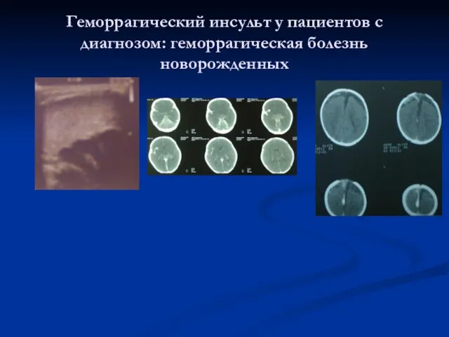 Геморрагический инсульт у пациентов с диагнозом: геморрагическая болезнь новорожденных