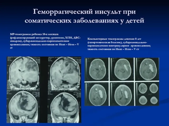 Геморрагический инсульт при соматических заболеваниях у детей МР-томограммы ребенка 10-и месяцев (рефлюксирующий