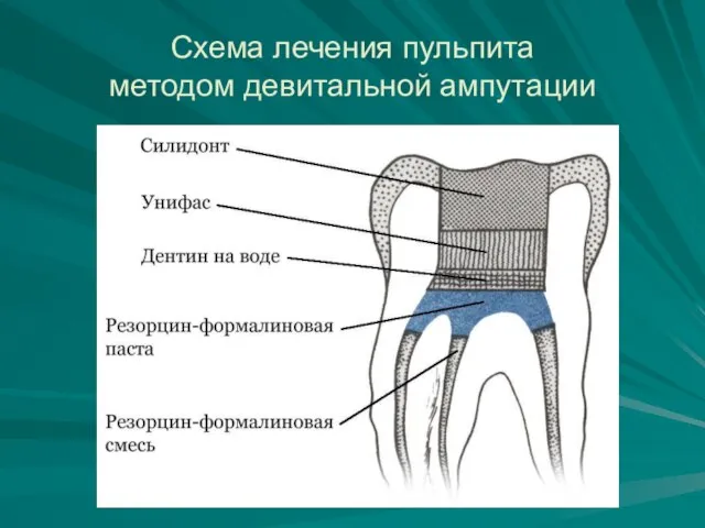 Схема лечения пульпита методом девитальной ампутации