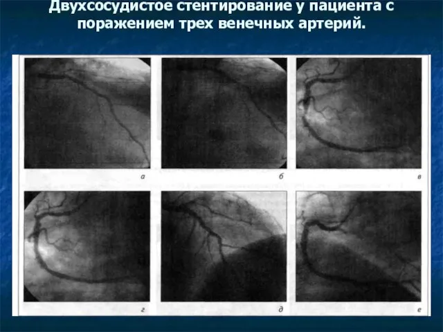 Двухсосудистое стентирование у пациента с поражением трех венечных артерий.