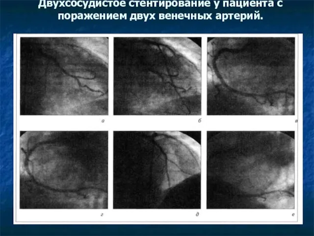 Двухсосудистое стентирование у пациента с поражением двух венечных артерий.