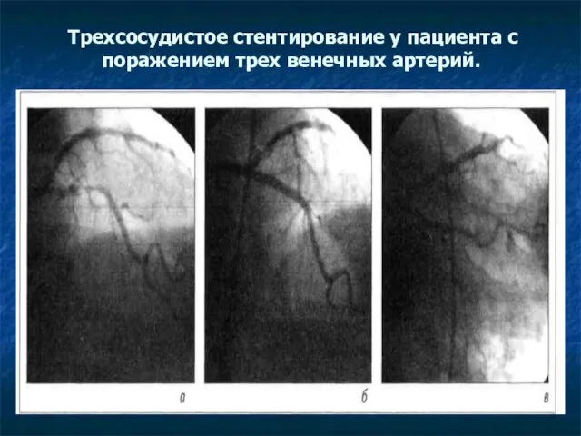 Трехсосудистое стентирование у пациента с поражением трех венечных артерий.