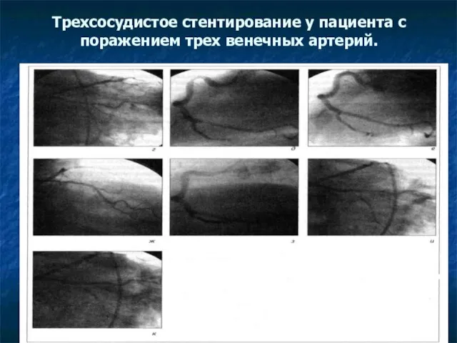 Трехсосудистое стентирование у пациента с поражением трех венечных артерий.