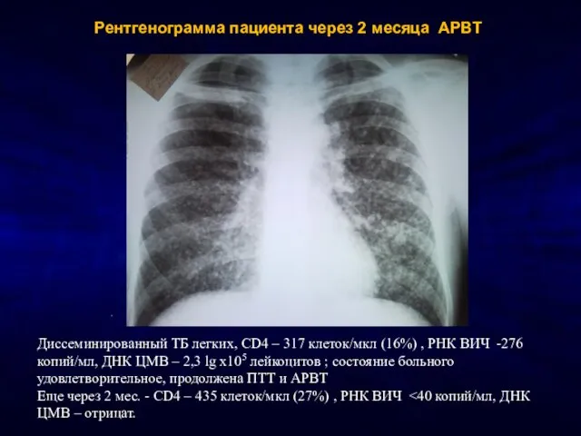 Рентгенограмма пациента через 2 месяца АРВТ Диссеминированный ТБ легких, CD4 – 317