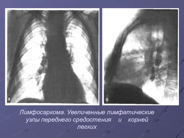 Лимфосаркома. Увеличенные лимфатические узлы переднего средостения и корней легких