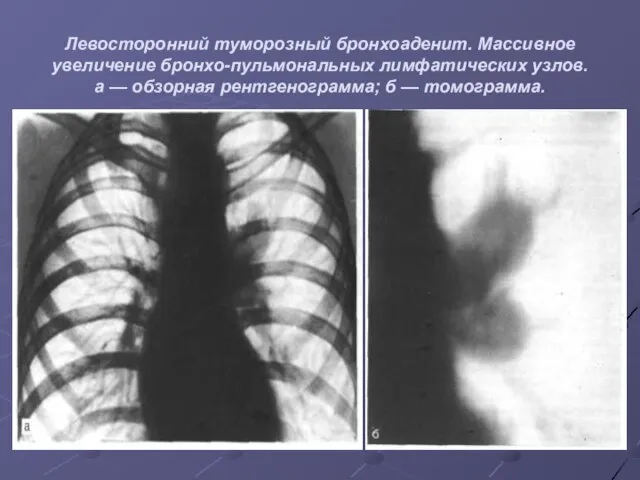 Левосторонний туморозный бронхоаденит. Массивное увеличение бронхо-пульмональных лимфатических узлов. а — обзорная рентгенограмма; б — томограмма.