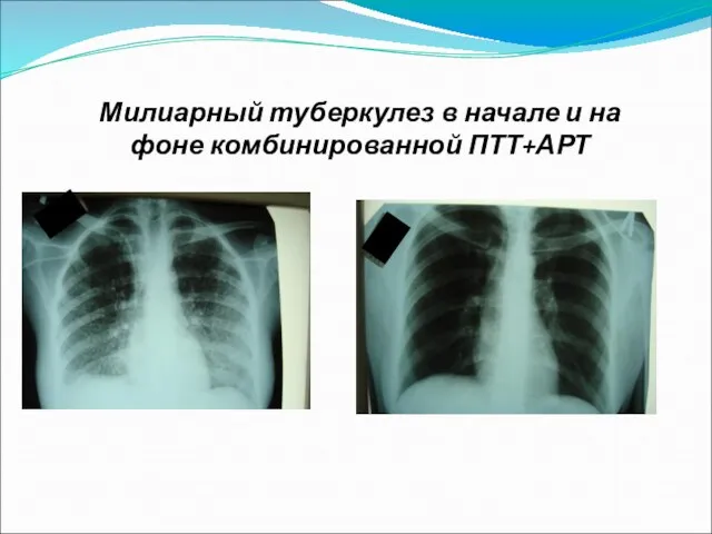 Милиарный туберкулез в начале и на фоне комбинированной ПТТ+АРТ