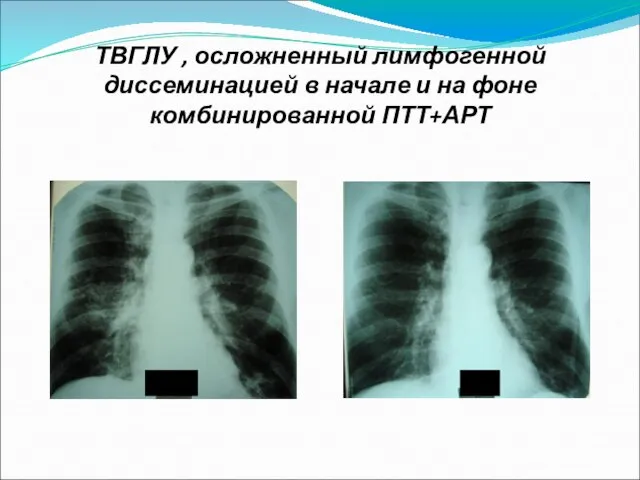 ТВГЛУ , осложненный лимфогенной диссеминацией в начале и на фоне комбинированной ПТТ+АРТ