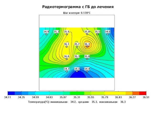 Радиотермограмма с ГБ до лечения