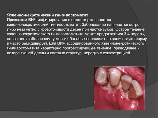 Язвенно-некротический гингивостоматит Признаком ВИЧ-инфицирования в полости рта является язвеннонекротический гингивостоматит. Заболевание начинается