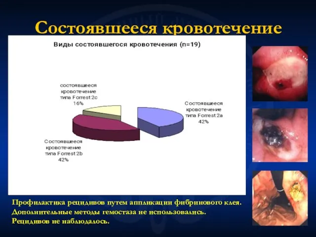 Состоявшееся кровотечение Профилактика рецидивов путем аппликации фибринового клея. Дополнительные методы гемостаза не использовались. Рецидивов не наблюдалось.