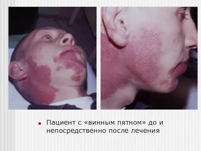 Пациент с «винным пятном» до и непосредственно после лечения