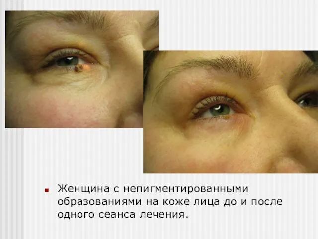 Женщина с непигментированными образованиями на коже лица до и после одного сеанса лечения.
