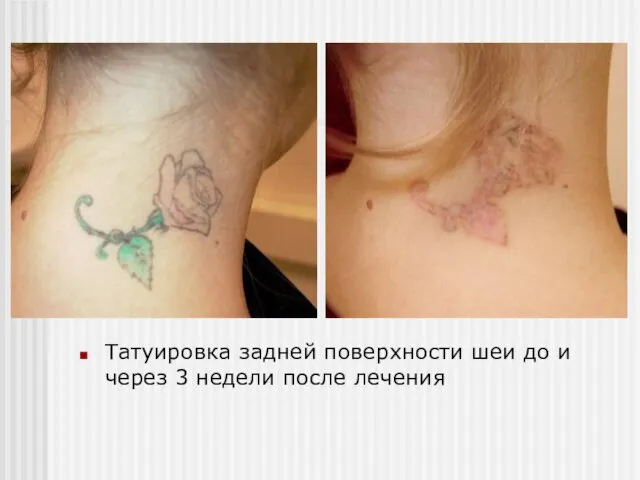 Татуировка задней поверхности шеи до и через 3 недели после лечения