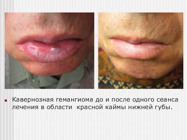 Кавернозная гемангиома до и после одного сеанса лечения в области красной каймы нижней губы.