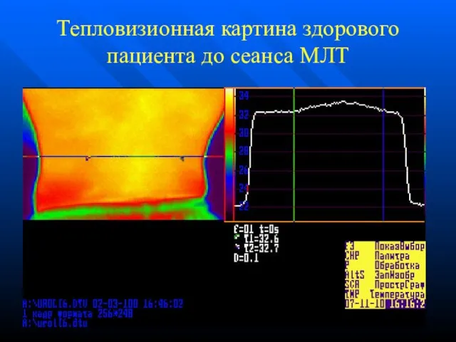 Тепловизионная картина здорового пациента до сеанса МЛТ