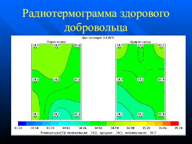 Радиотермограмма здорового добровольца