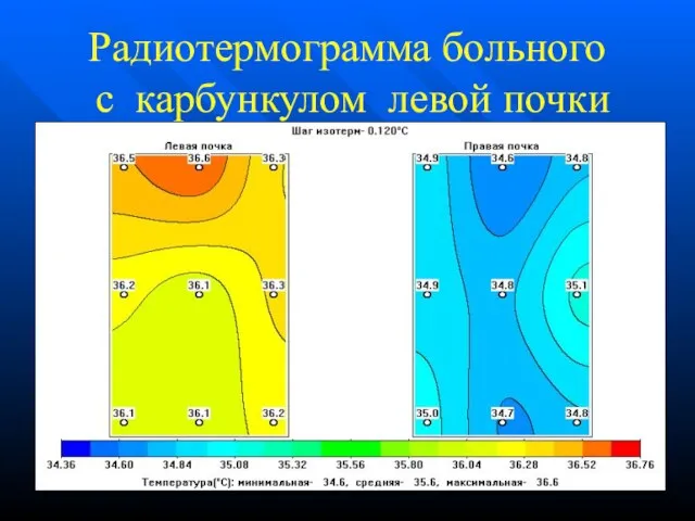 Радиотермограмма больного с карбункулом левой почки