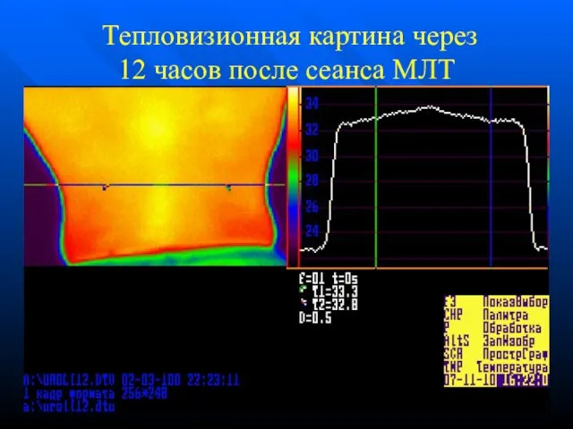 Тепловизионная картина через 12 часов после сеанса МЛТ