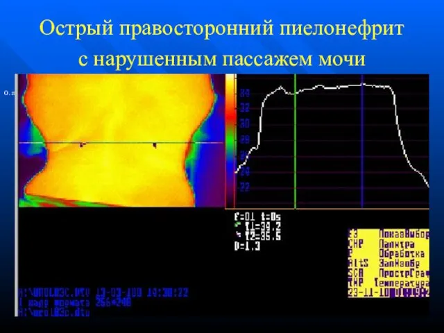 Острый правосторонний пиелонефрит с нарушенным пассажем мочи О. правостор.пиелонефрит с нарушенным пассажем мочи